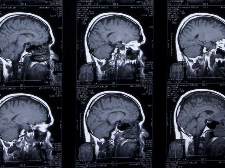 Schizofrenia i depresja – patofizjologia