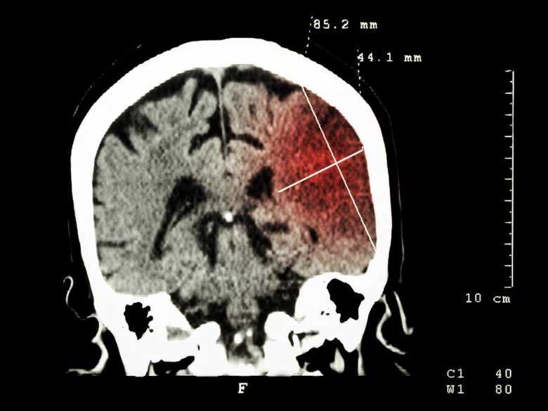 Schizofrenia – trendy w diagnostyce