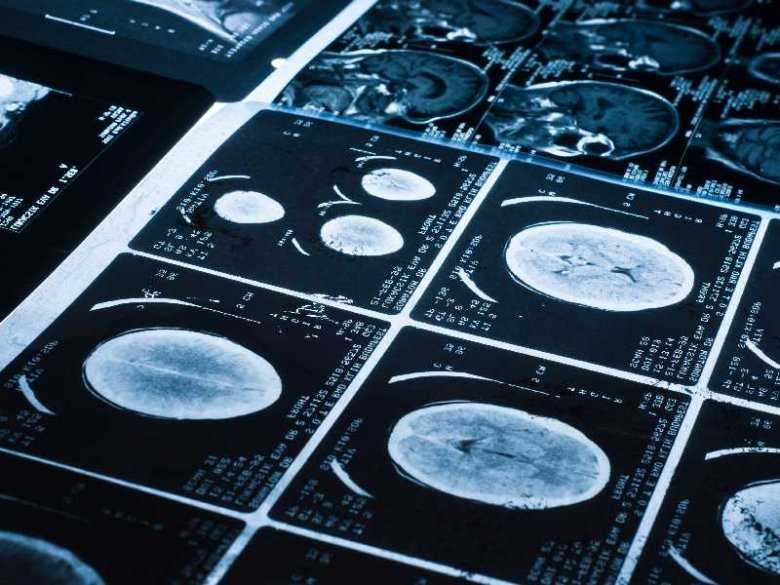 Padaczka skroniowa u dzieci a zmiany stwierdzane w badaniu rezonansu magnetycznego