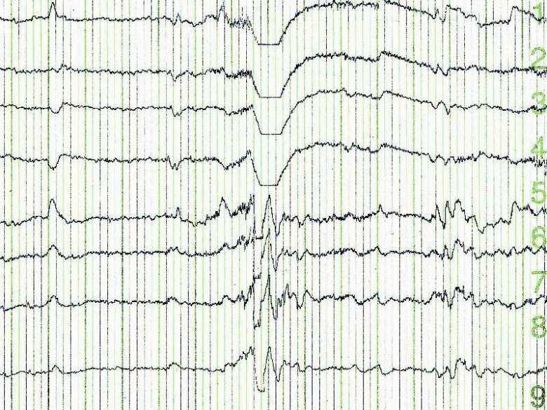 EEG biofeedback - nowa metoda terapeutyczna w psychiatrii