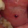 guzek pod policzkiem