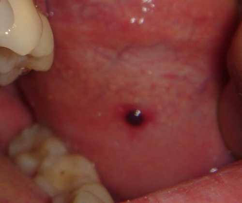 guzek pod policzkiem