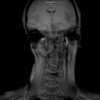 Mri szyja