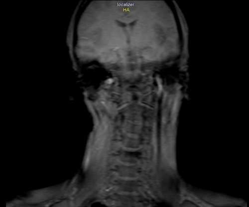 Mri szyja