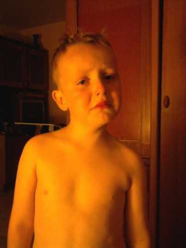 moj syn po adenotomi 2