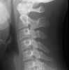 a implant siedzi grzecznie na miejscu:)