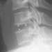 implant