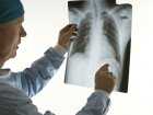 Gruźlica płuc u dzieci: część 3