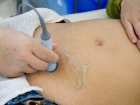 Mięśniak macicy w ciąży – poznaj przyczyny i sposoby leczenia!
