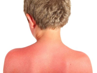 Już po 30 minutach ekspozycji na słońcu twoja skóra może być czerwona! Wpływ na to ma warstwa ozonowa i poziom UV