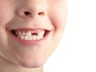 Zęby mleczne jak dbać o nie oraz o przestrzeń po ich wypadnięciu?
