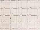 Diagnostyka przez badania EKG