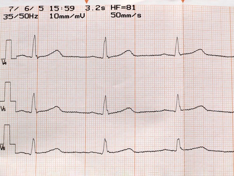 Wydruk z badania EKG