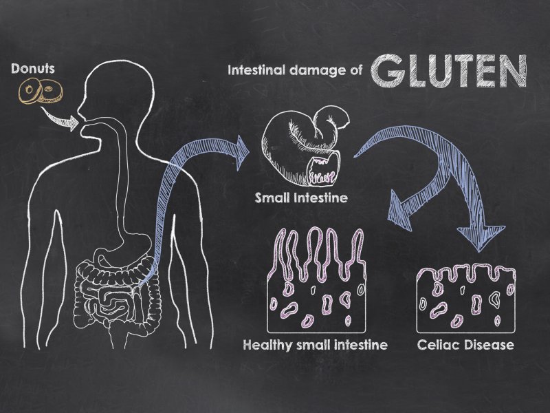 Nietolerancja glutenu