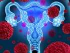 Wirus HPV a rak jajnika: czy patogen sprzyja temu nowotworowi?