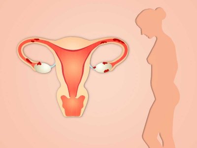 Dostęp do immunoterapii wyrówna szanse Polek w walce z rakiem endometrium