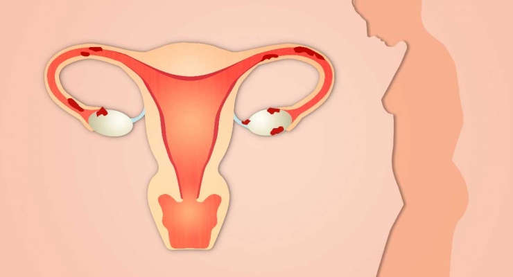 Immunoterapia wyrówna szanse w walce z rakiem endometrium