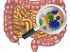 Bakterie jelitowe mogą mieć wpływ na rozwój nowotworu jelita grubego