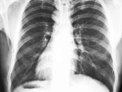 Klatka piersiowa kurza - przyczyny, objawy, diagnoza, leczenie