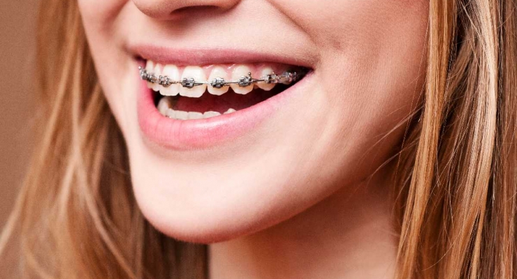 Aparat ortodontyczny – moda czy potrzeba?