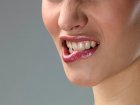 Owrzodzenia w jamie ustnej