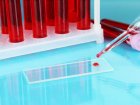 Badania krwi posłużą różnicowaniu schorzeń ze spektrum parkinsonizmu?