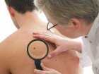 Rak skóry - ryzyko zachorowania