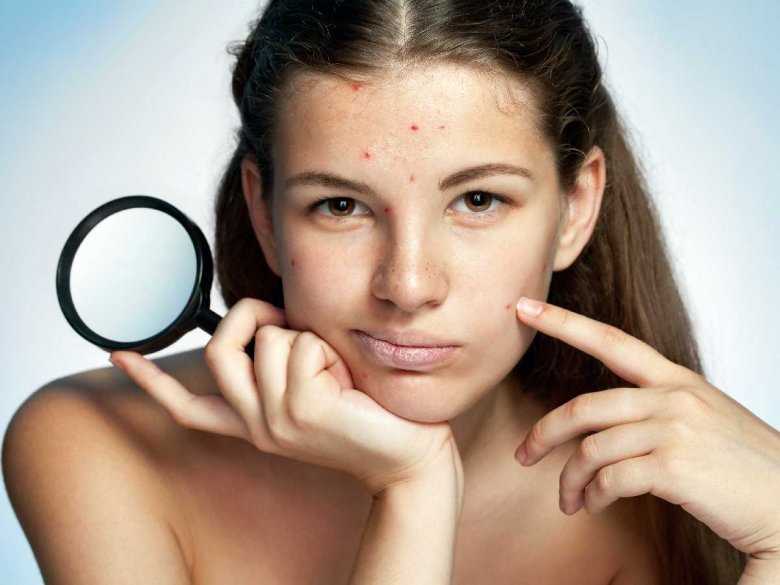 Rola układu immunologicznego a występowanie trądziku różowatego