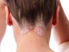 Łuszczyca skóry głowy – przyczyny, objawy i leczenie