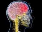 Ropień mózgu: jakie są jego przyczyny, objawy i jak go leczyć?