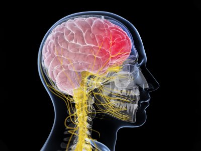 Ropień mózgu: jakie są jego przyczyny, objawy i jak go leczyć?