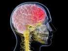 Niestabilna blaszka miażdżycowa przyczyną udaru niedokrwiennego mózgu