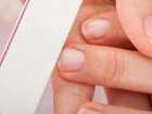 Zmiany płytki paznokcia a grzybica