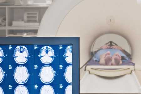 Padaczka lepiej diagnozowana dzięki MRI z silniejszym polem magnetycznym