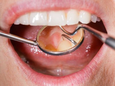 Niepróchnicowe ubytki tkanek twardych zęba