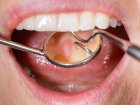 Niepróchnicowe ubytki tkanek twardych zęba