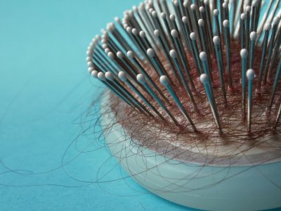 Wypadanie włosów - przyczyny, objawy, diagnoza, leczenie