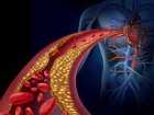 Guzkowe zapalenie tętnic - przyczyny, objawy, diagnoza, leczenie