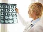 Tętniak mózgu - przyczyny, objawy, diagnoza, leczenie