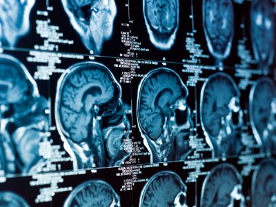 Guz przysadki mózgowej - przyczyny, objawy, diagnoza, leczenie
