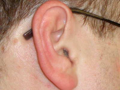 Czy występowanie zapaleń ucha środkowego u rodziców zwiększa ryzyko choroby u dziecka?