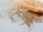 Wypadanie włosów – trzy rodzaje zawstydzającej choroby