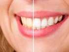Laserowe wybielanie zębów - istota zabiegu?
