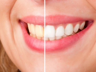 Laserowe wybielanie zębów - istota zabiegu?