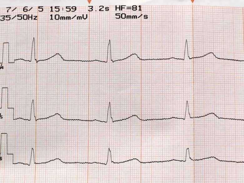 Wydruk z badania EKG