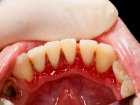 Białaczka a krwawienia i zmiany w jamie ustnej