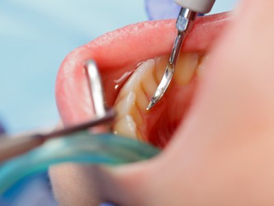 Zęby zatrzonowe – rzadkie przypadki