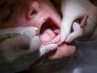 Podrażnienia i uszkodzenia w jamie ustnej