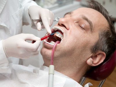 Chemiczne wybielanie zębów - czy jest bezpieczne?