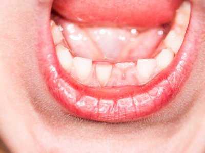 Grzybicze zapalenie jamy ustnej - objawy, diagnoza, leczenie